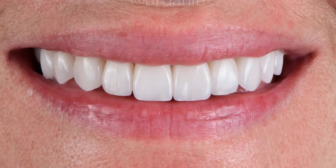 After treatment