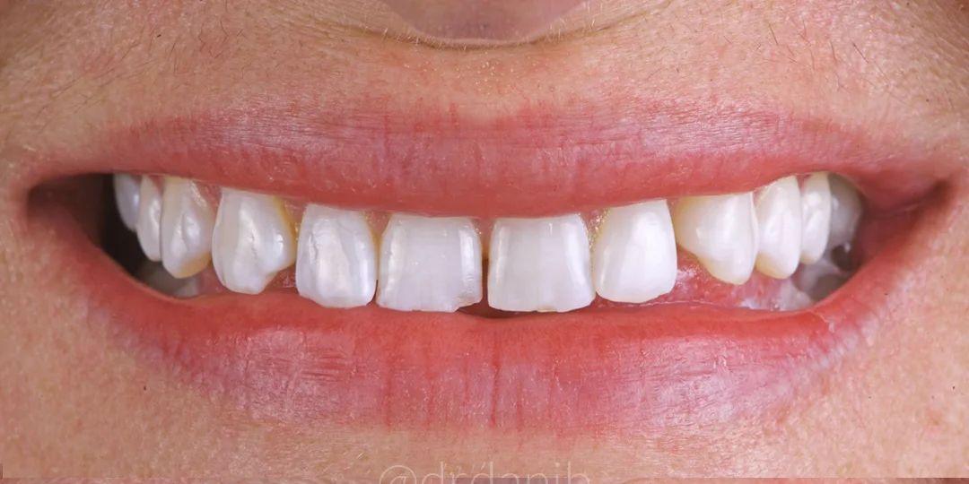 Before treatment