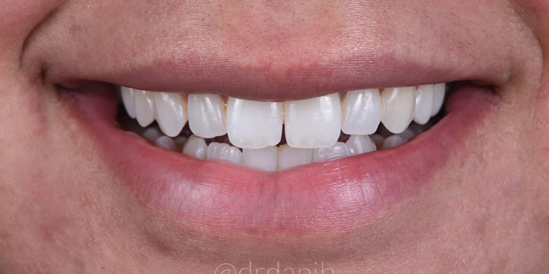 Before treatment