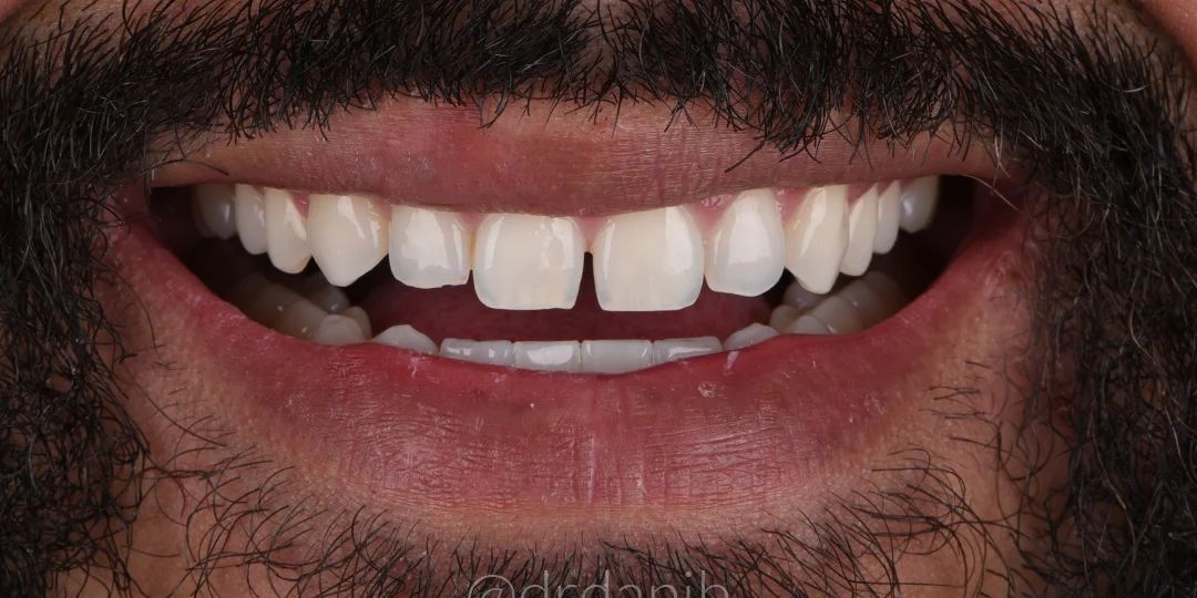 Before treatment
