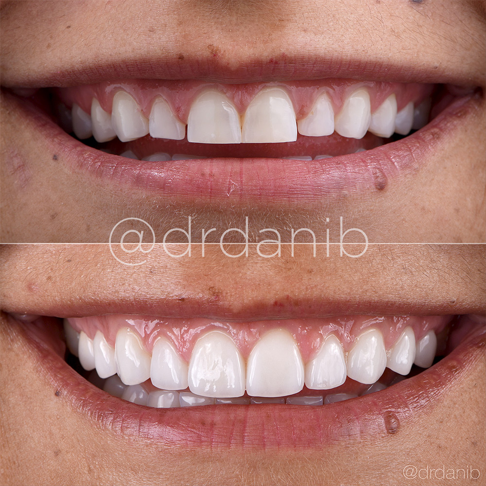 Porcelain Veneers in Los Angeles