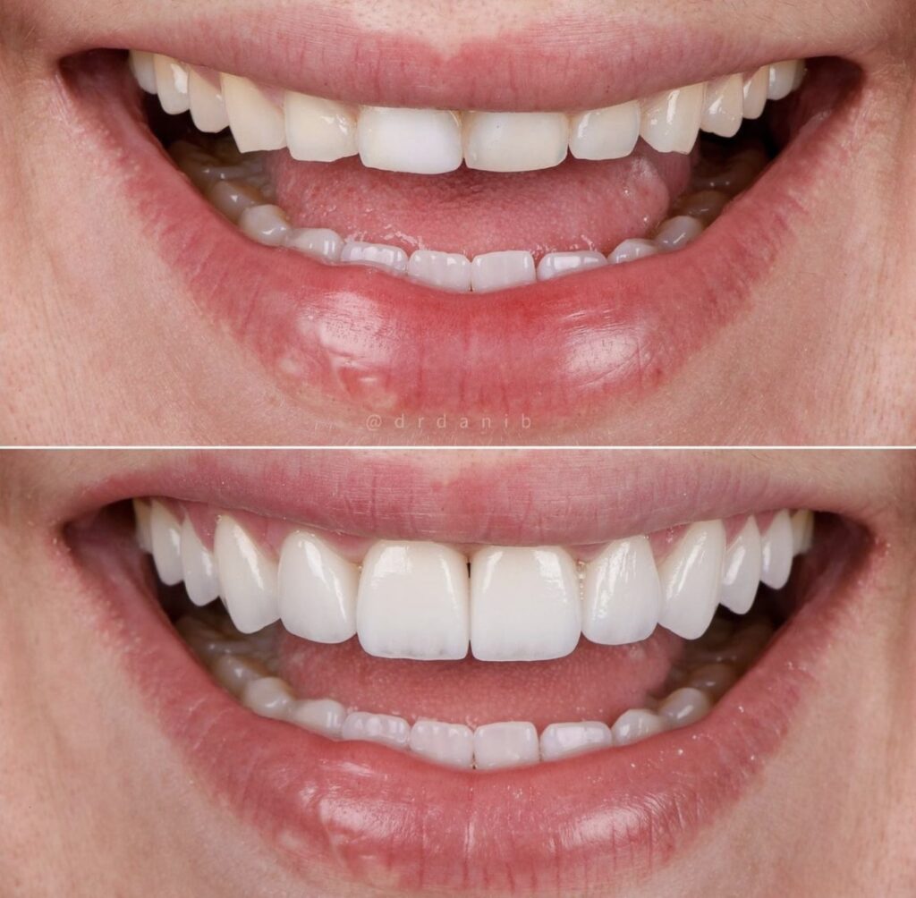 porcelain-veneers-los-angeles