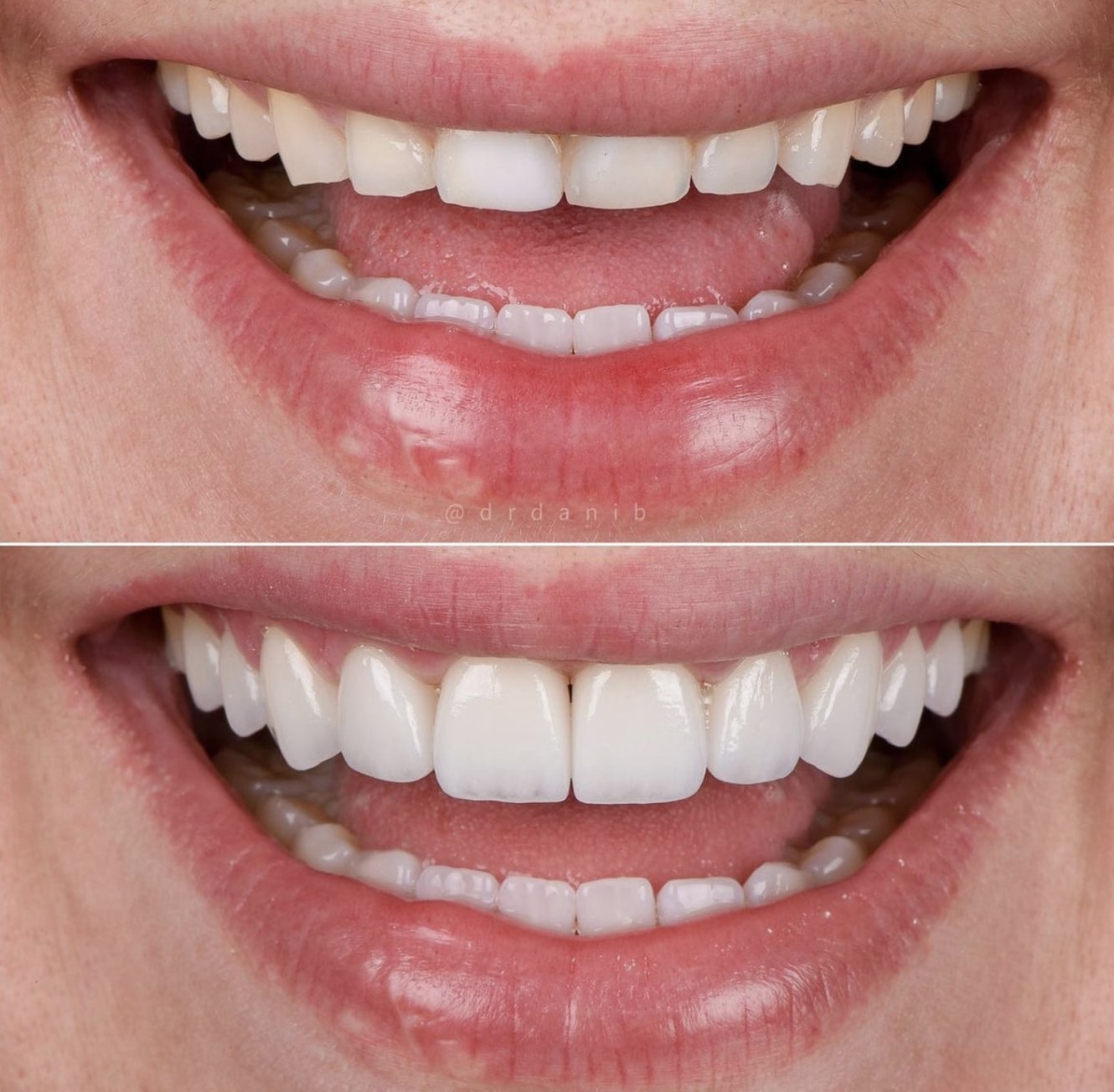 Porcelain veneer result from the official practice gallery