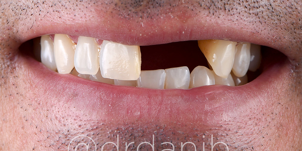 cosmetic dentistry-los-angeles