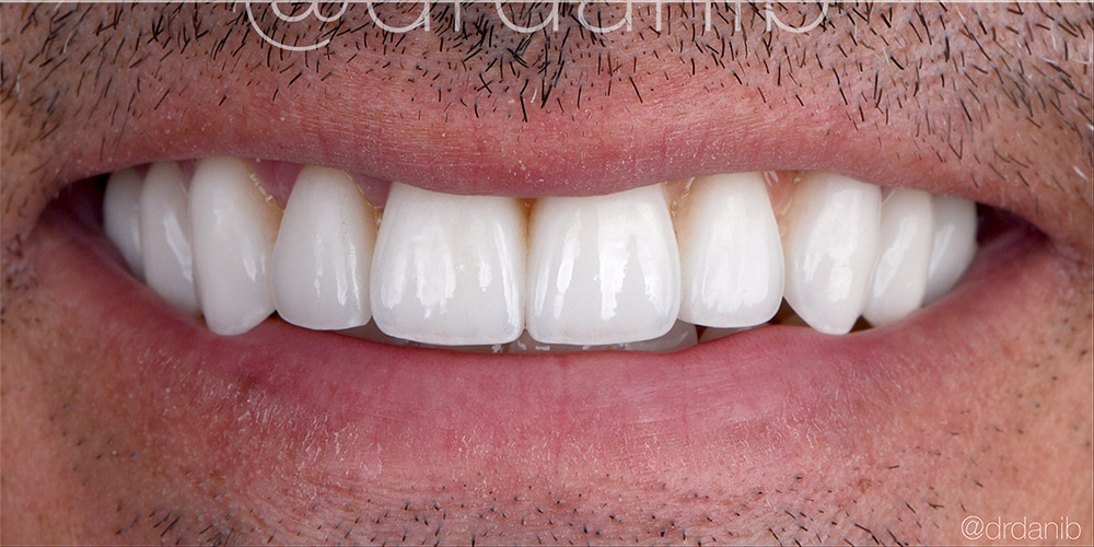 cosmetic dentistry-los-angeles