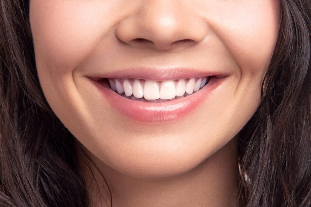 Close-up of a natural-looking, even smile illustrating Porcelain Veneers Los Angeles for improving tooth shape, color, and overall smile appearance