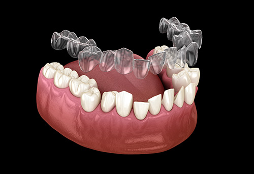 Invisalign Dentist in Los Angeles for Customized, Clear Teeth Alignments and Smile Transformations