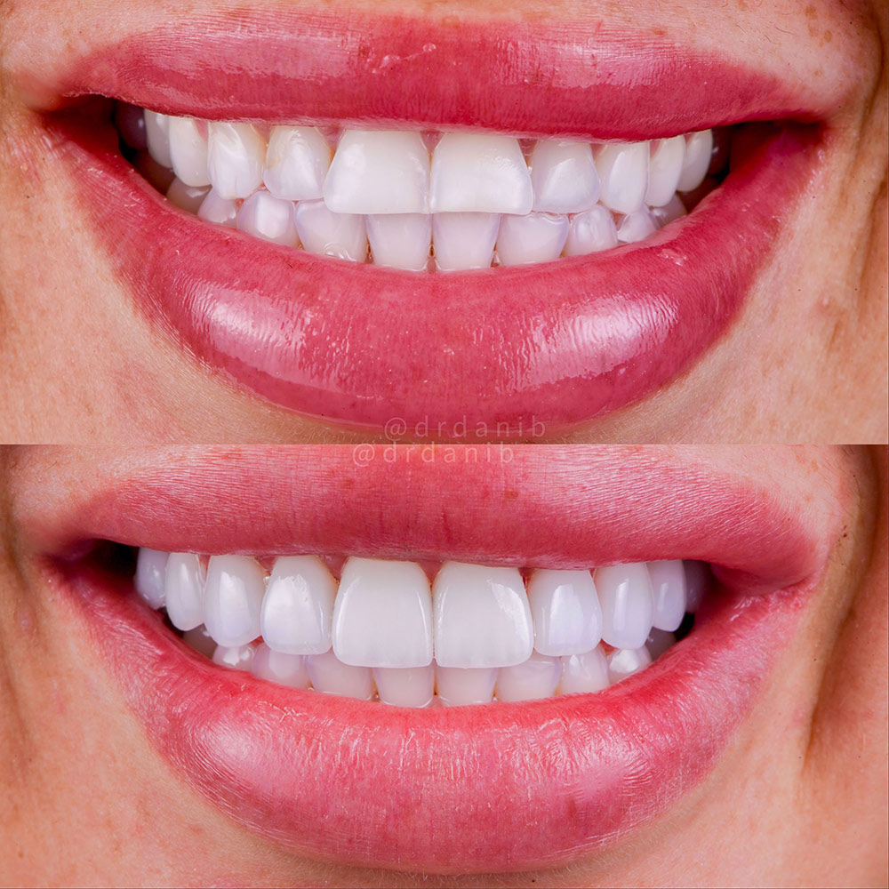Before-and-after images by Dr. Dani B in Los Angeles showcasing how porcelain veneers can enhance tooth shape, color, and overall aesthetics.