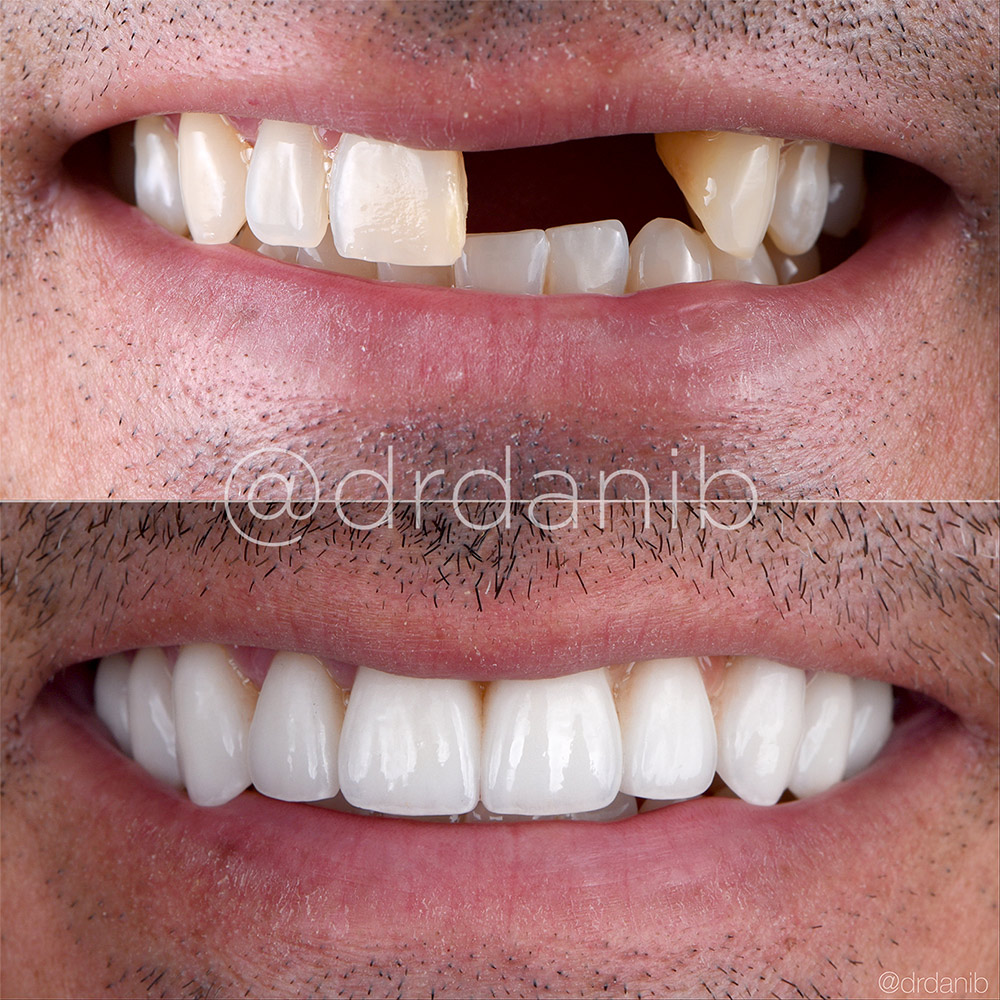 Before-and-after transformation featuring a porcelain bridge by Dr. Dani B in Los Angeles, showcasing advanced restorative dentistry for a natural, confident smile.