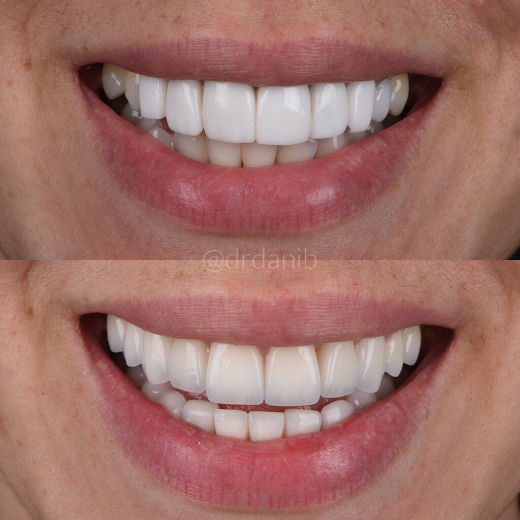 Cosmetic Dentistry by Dr. Dani B in Los Angeles for Expert Smile Enhancements