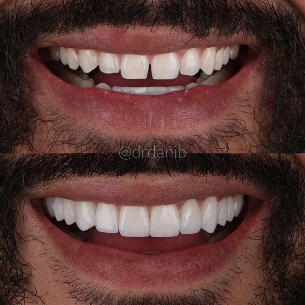 Veneers in Los Angeles for Beautiful, Natural-Looking Smile Enhancements