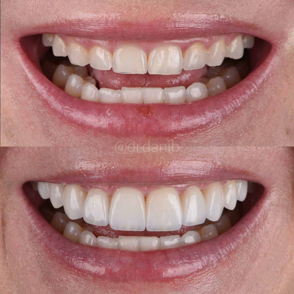 Top Cosmetic Dentistry Services in Los Angeles for Stunning Smile Makeovers