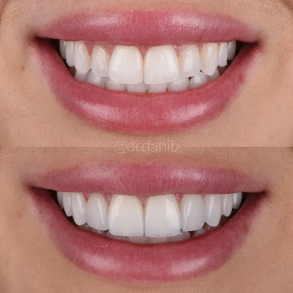 Before and after photos demonstrating the transformative results of cosmetic dentistry performed by Dr. Dani B. in Los Angeles, showcasing significant improvements in smile aesthetics and dental health.
