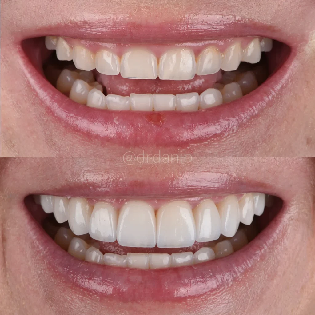 Dr. Dani B., a dentist in Los Angeles, shown a before after of porcelain veneers