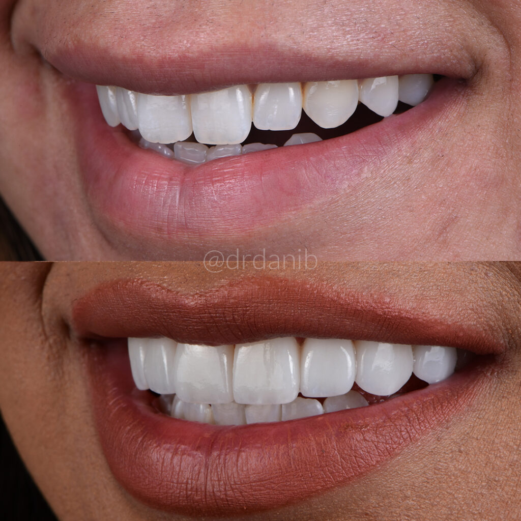 Before and after photos highlighting the dramatic smile transformations achieved with dental veneers by Dr. Dani B., showcasing improved tooth color, shape, and overall aesthetics.