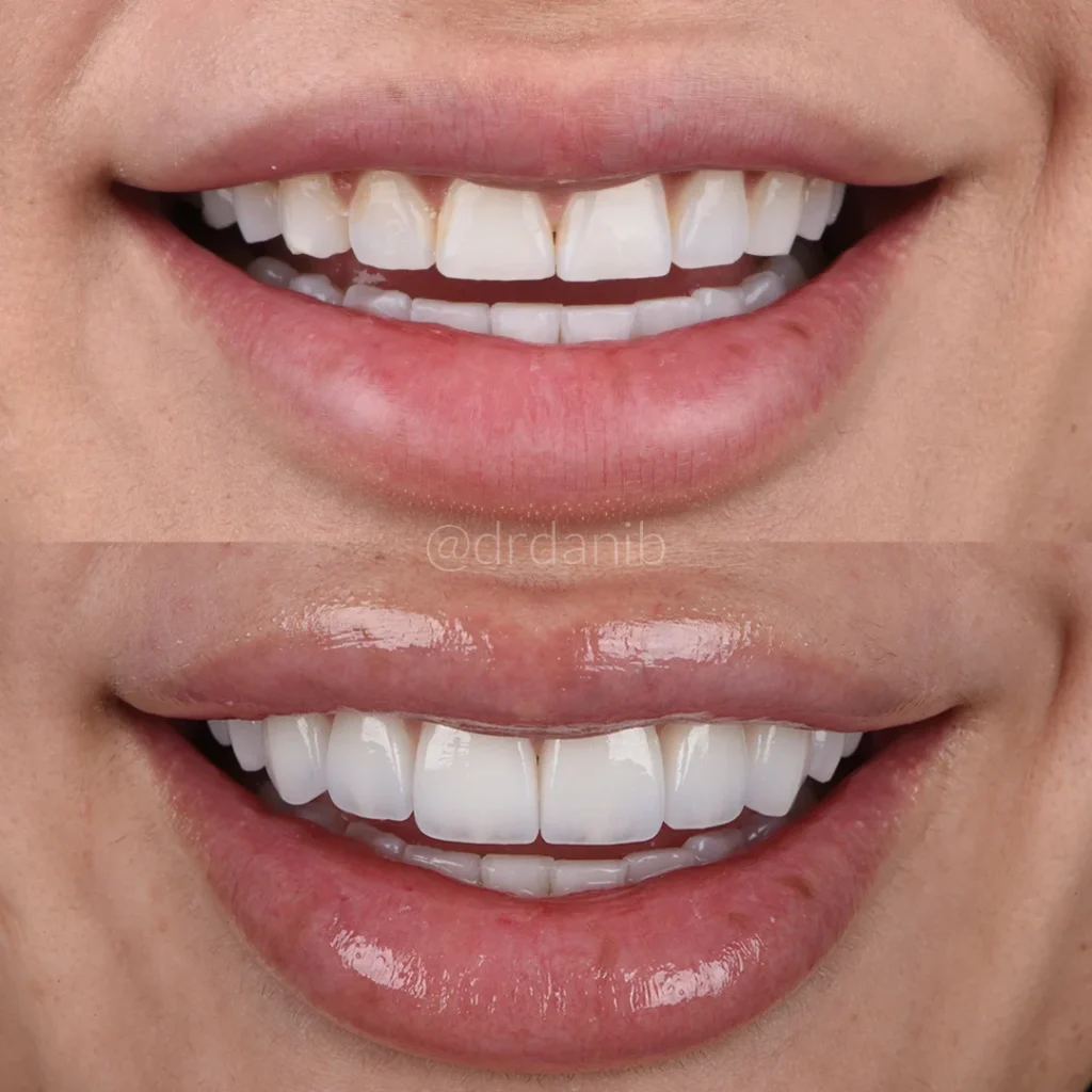 Dr. Dani B., positioned in his Los Angeles dental clinic, expertly handling porcelain crowns, illustrating his proficiency in cosmetic and restorative dental treatments designed to enhance patient smiles.