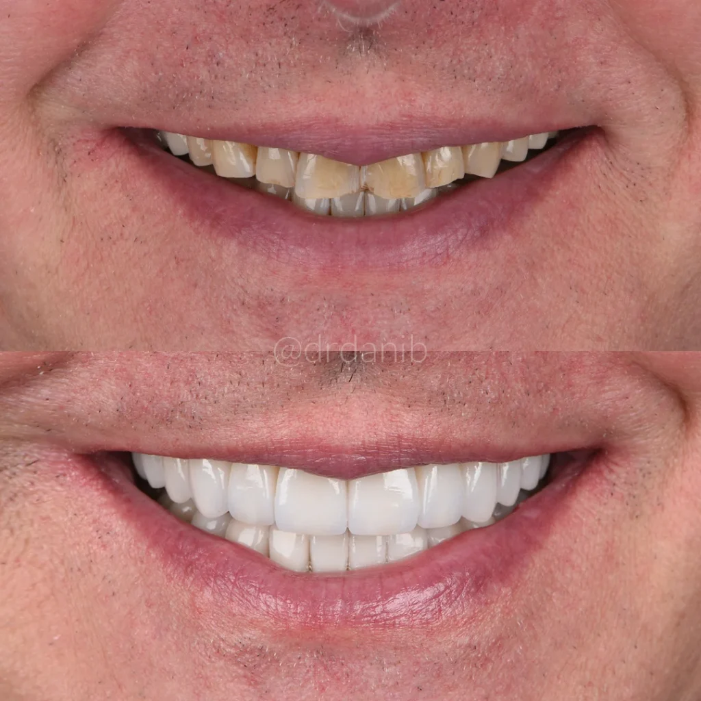 Dr. Dani B., a renowned dentist in Los Angeles, shown with a display of dental veneers, highlighting his expertise in cosmetic dentistry to enhance and transform patient smiles.