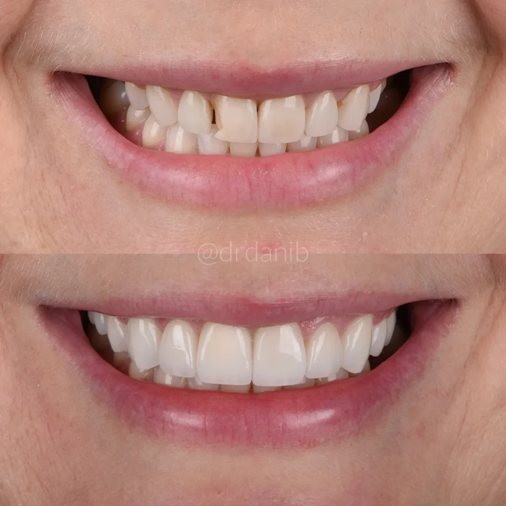 Before and after photos displaying the outcomes of general dentistry treatments by Dr. Dani B. in Los Angeles, highlighting improvements in dental health and aesthetics.