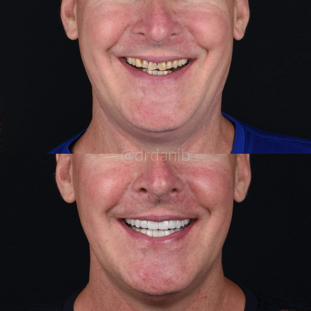 Before and after photos showcasing the transformative effects of porcelain veneers applied by Dr. Dani B. in Los Angeles, highlighting significant improvements in tooth appearance and smile aesthetics.