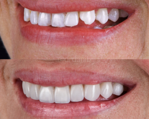 Veneers