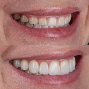 Veneers