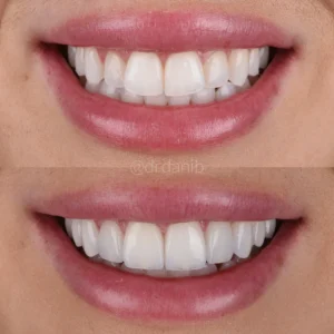 Veneers Before & After By Dr. Dani B
