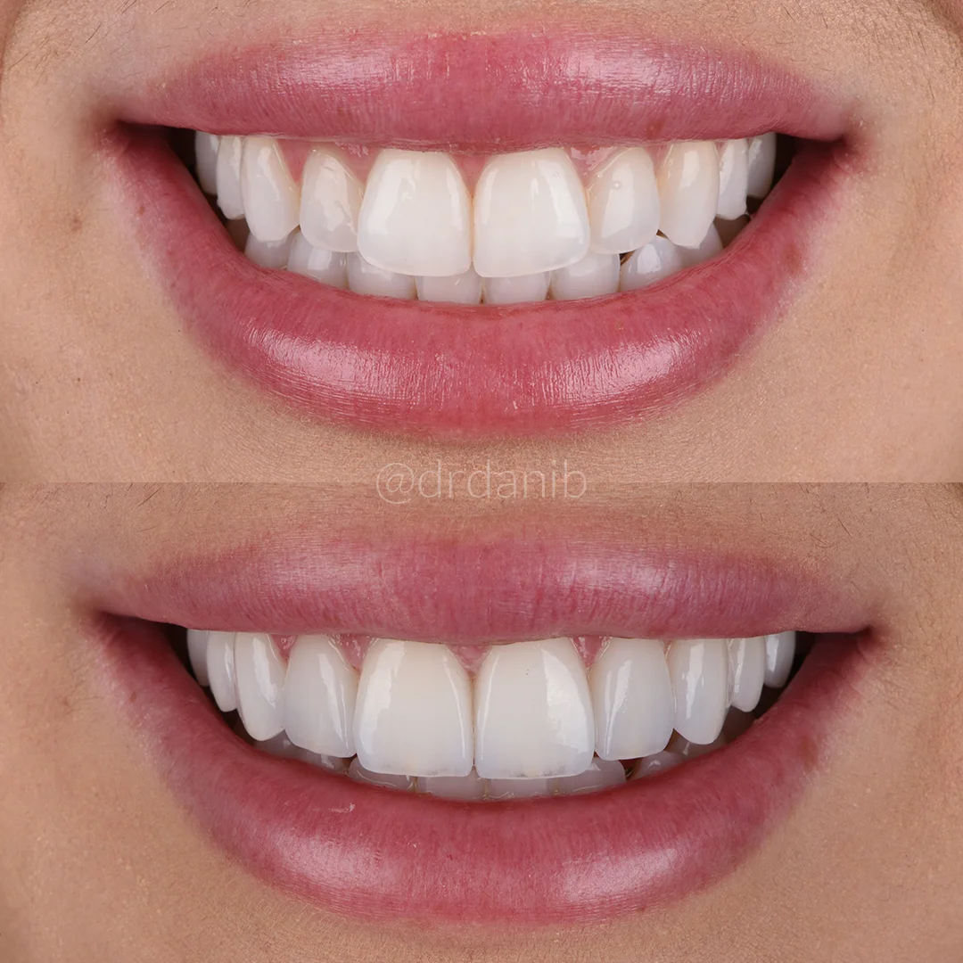 Before and after photos demonstrating the transformative results of cosmetic veneers dentistry performed by Dr. Dani B. in Los Angeles, showcasing significant improvements in smile aesthetics and dental health.