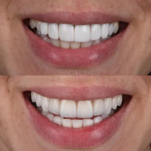 Veneers Before & After By Dr. Dani B