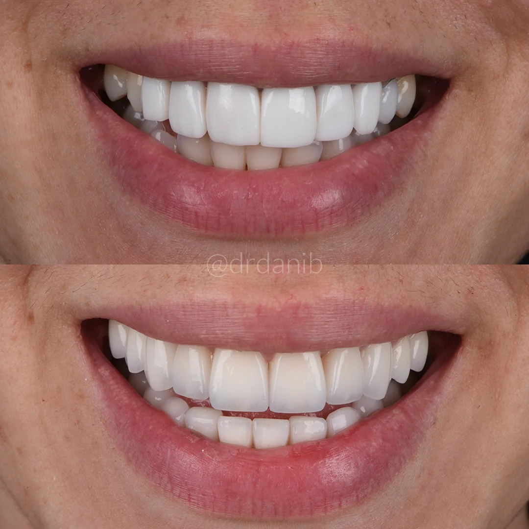 Before and after photos illustrating the successful placement of dental veneers by Dr. Dani B. in Los Angeles, showing significant restoration of patient smiles with enhanced functionality and aesthetics.