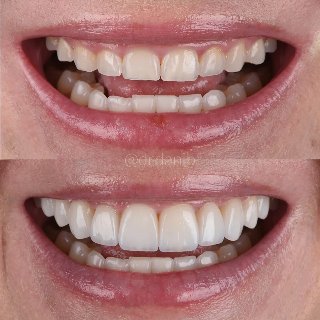 Dr. Dani B., a dentist in Los Angeles, shown a before after of porcelain veneers