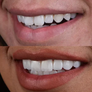 Veneers Before & After By Dr. Dani B