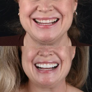 Veneers Before & After By Dr. Dani B
