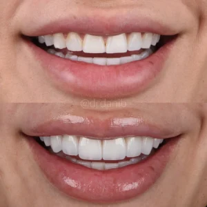 Veneers Before & After By Dr. Dani B