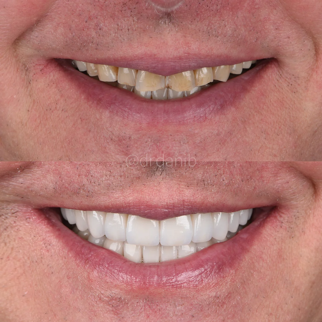 Dr. Dani B., a renowned dentist in Los Angeles, shown with a display of dental veneers, highlighting his expertise in cosmetic dentistry to enhance and transform patient smiles.