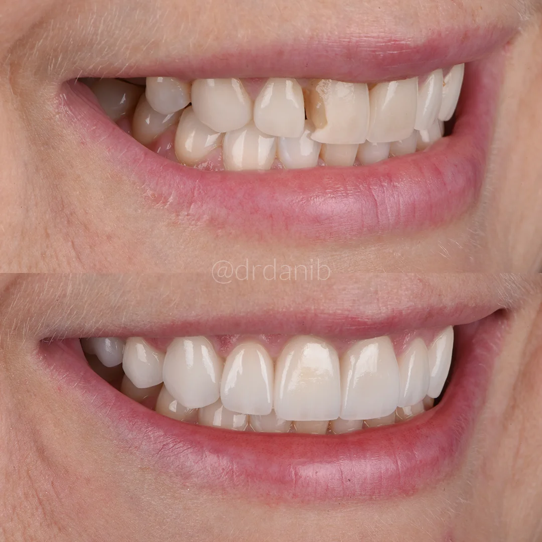 Before and after photos from Dr. Dani B.'s emergency dental veneer treatments in Los Angeles, illustrating rapid and effective restoration of patient smiles following urgent dental issues.