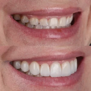 Veneers Before & After By Dr. Dani B