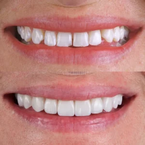 Veneers Before & After By Dr. Dani B