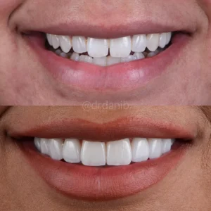 Veneers Before & After By Dr. Dani B