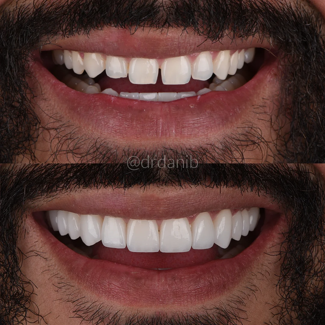 Veneers Los Angeles Before & After By Dr. Dani B