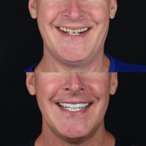 Veneers Before & After By Dr. Dani B
