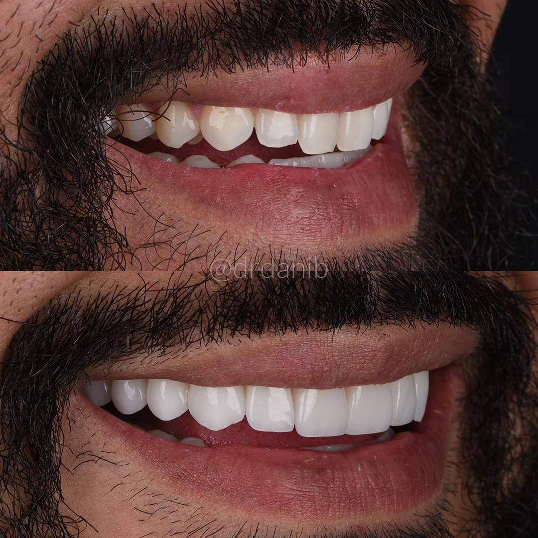 Veneers Before & After By Dr. Dani B Los Angeles