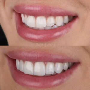 Veneers Before & After By Dr. Dani B
