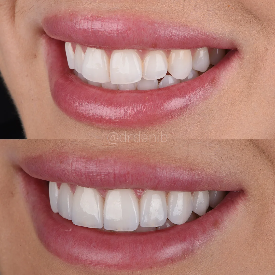 No-Prep-Veneers-Specialist-Los-Angeles-Before-After