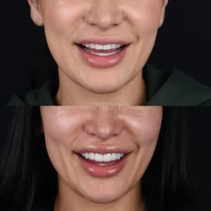 Veneers Before & After By Dr. Dani B