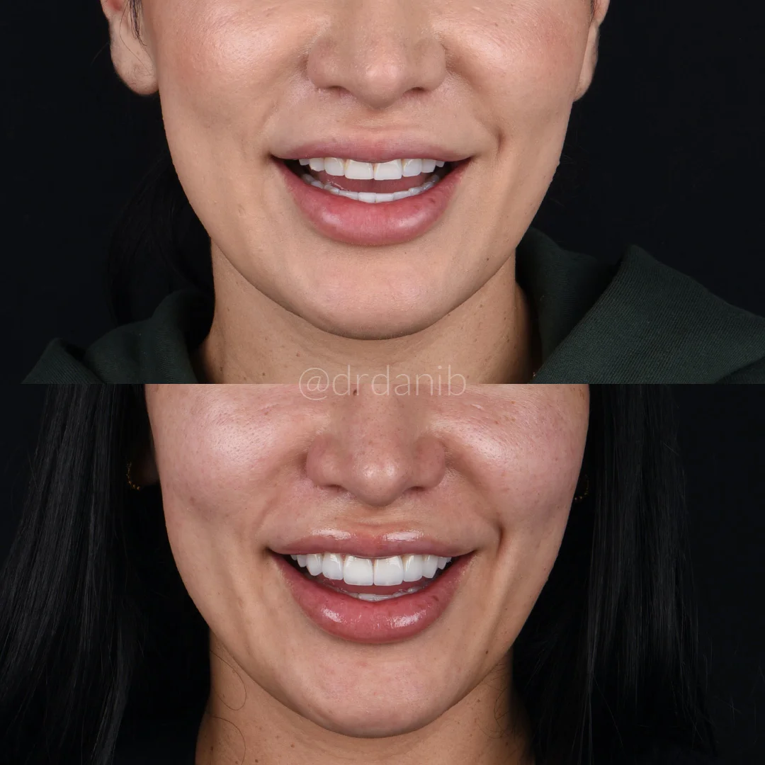 Veneers-Before & After-Los-Angeles-Dr.-Dani-B