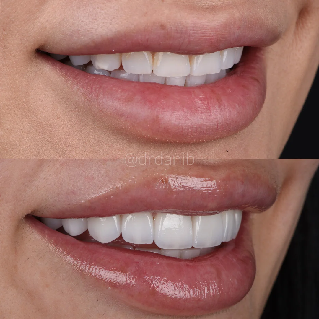 Veneers Before & After By Dr. Dani B