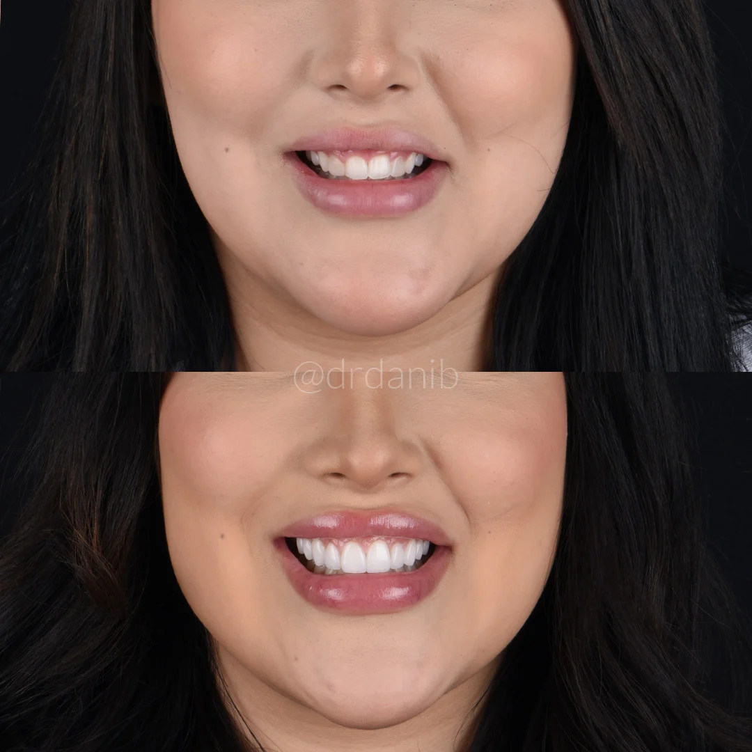 Before and after images of a patient’s smile transformation with porcelain veneers by Dr. Dani B., a dentist in Los Angeles, highlighting the aesthetic improvements and smile enhancement.