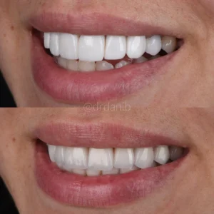 Veneers Before & After By Dr. Dani B