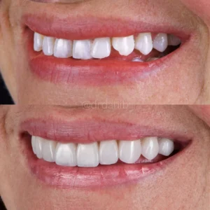 Veneers Before & After By Dr. Dani B