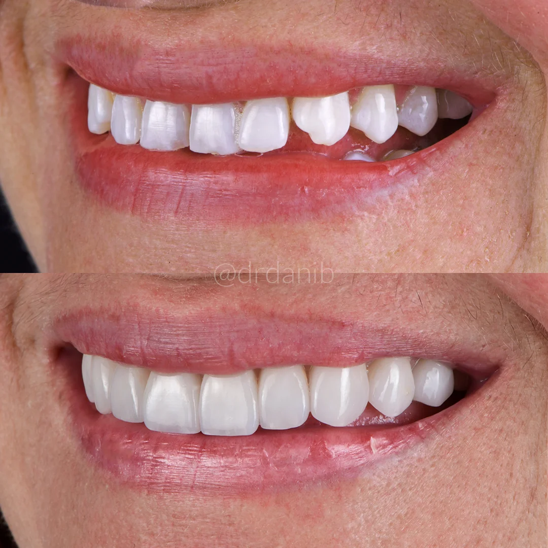 Porcelain-Veneers-Specialist-Los-Angeles-Before-After-Dr.-Dani-B